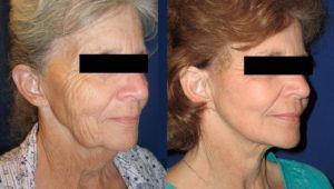Neck Lift Before & After Wall Township, NJ