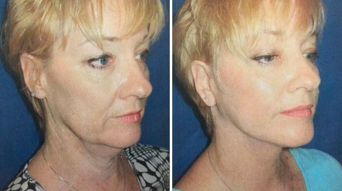 Lower Eyelid Lift Before & After Wall Township