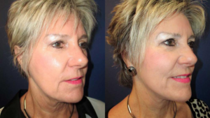 Facelift Before & After Wall Township, NJ