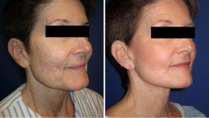 Neck Lift Before & After Wall Township
