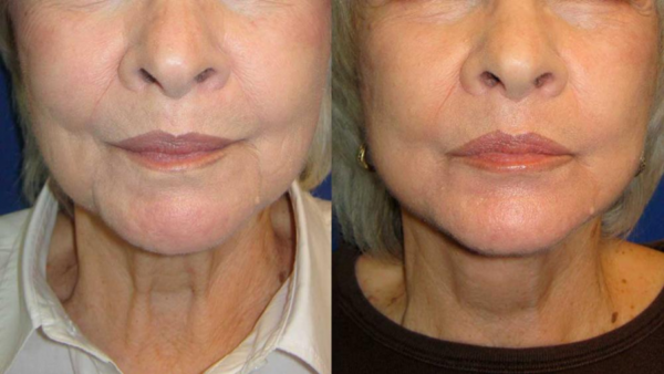 Neck Lift Before & After Wall Township, NJ